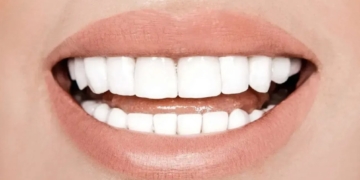 10 Secrets to Whiter Teeth
